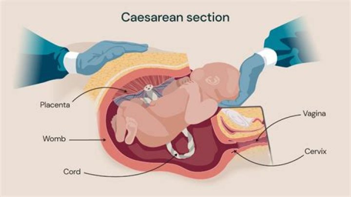 Was caesar born by c section?