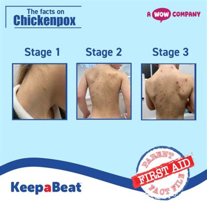 Were do chickenpox start?