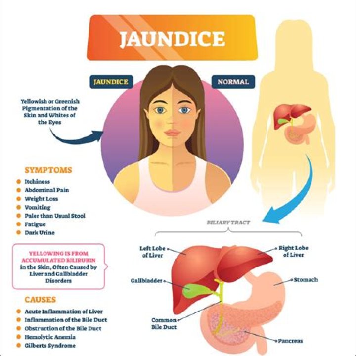 What are the jaundice symptoms?