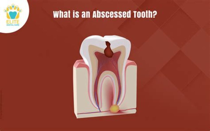 What helps abscessed tooth?