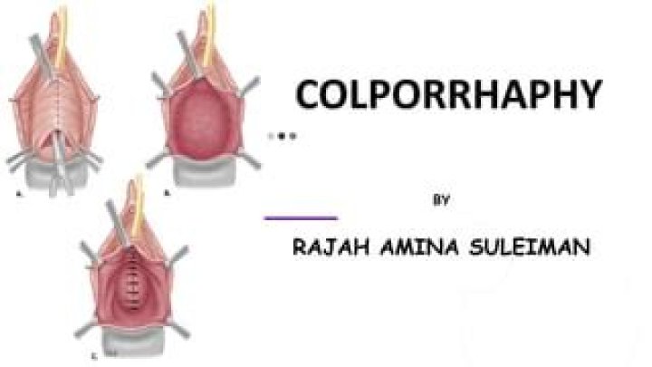 What is a posterior colpoperineorrhaphy?