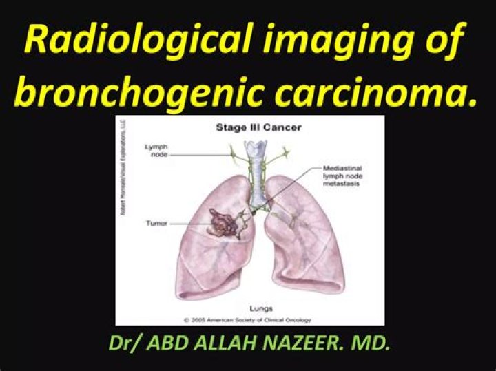 What is an early sign of bronchogenic carcinoma?