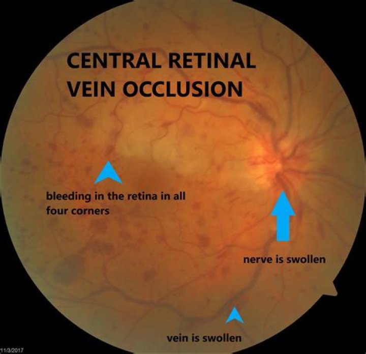 What is retinal vein occlusion?