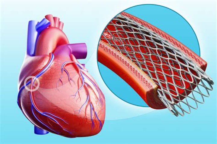 What is stent placement?