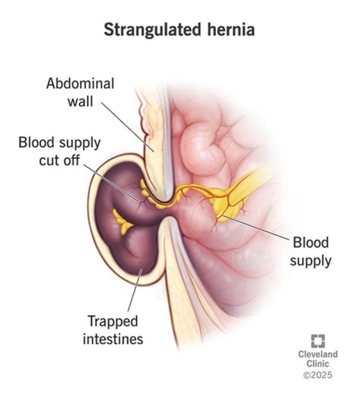 Whats a strangulated hernia?