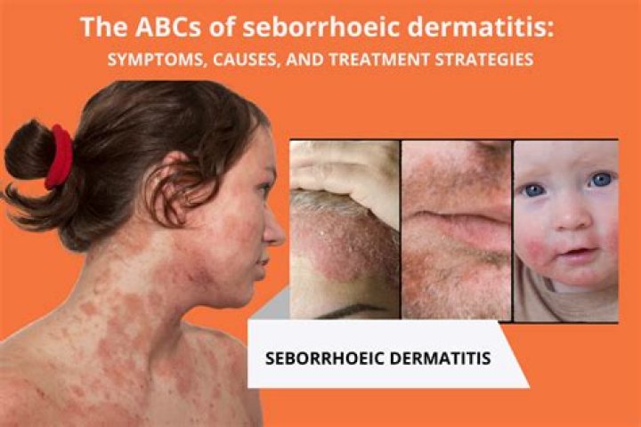When does seborrheic dermatitis go away in infants?