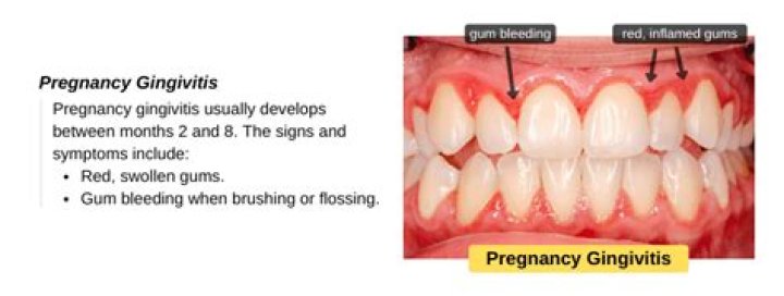 When is pregnancy gingivitis?