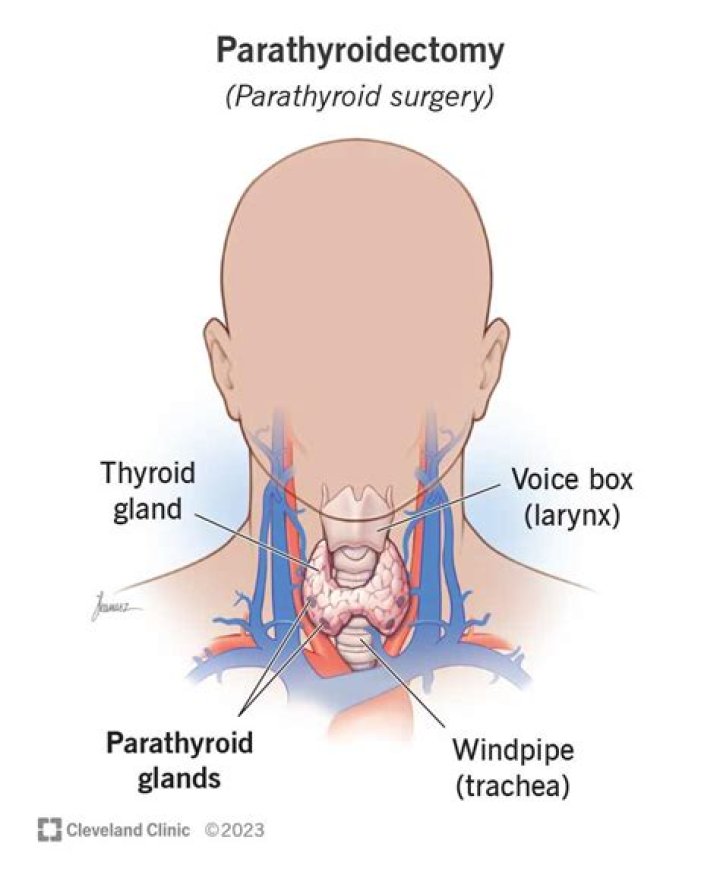 When should a parathyroidectomy be done?
