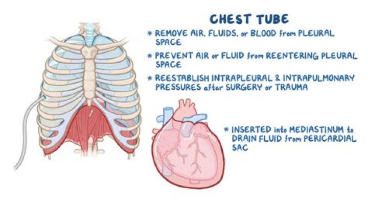 When to remove ctt for pneumothorax?