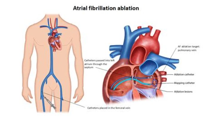 Where are ablations done?