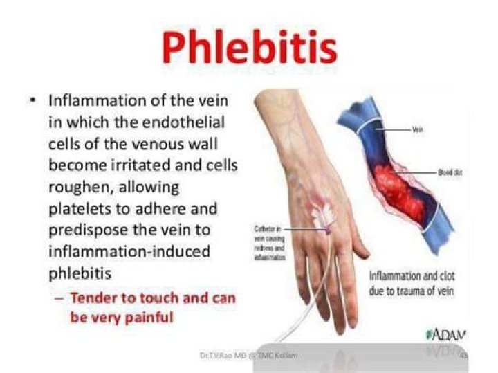 Where do you get phlebitis?