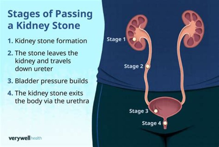 Where does a kidney stone pass through?