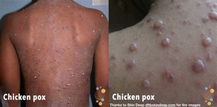 Where does chickenpox come from?