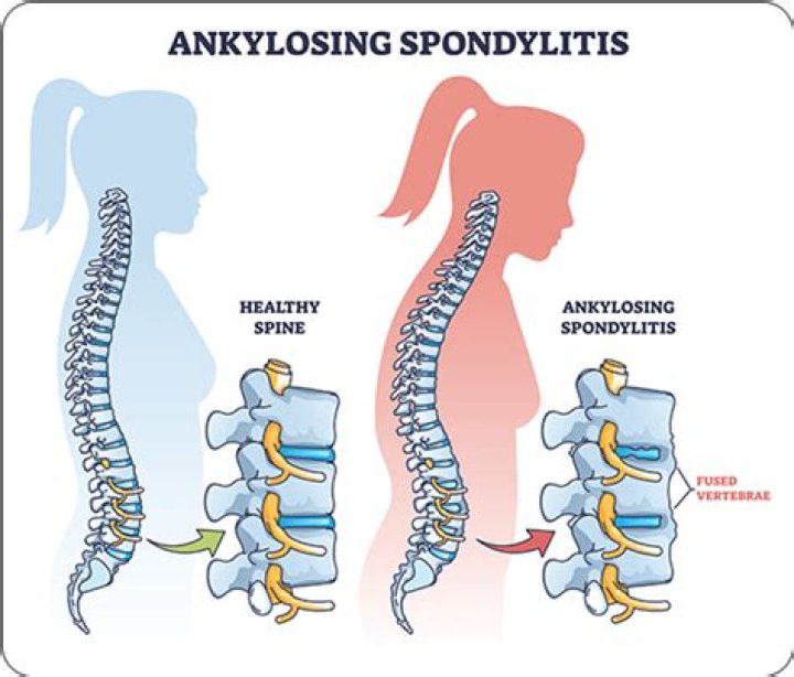 Where is spondylitis located?