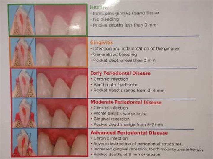 Which clinical gingival characteristic is a sign of disease?