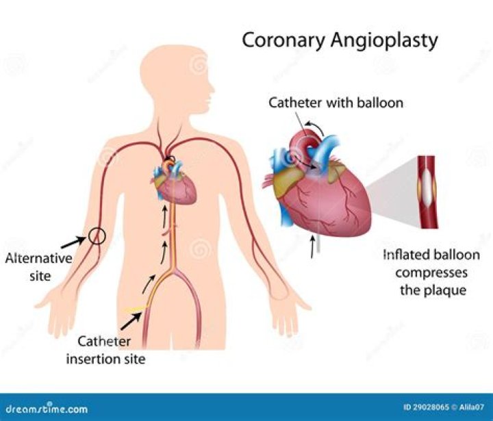 Which doctor does angioplasty?