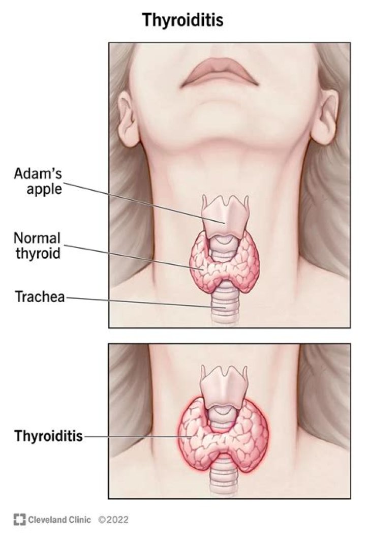 Which parasite causing thyroiditis?