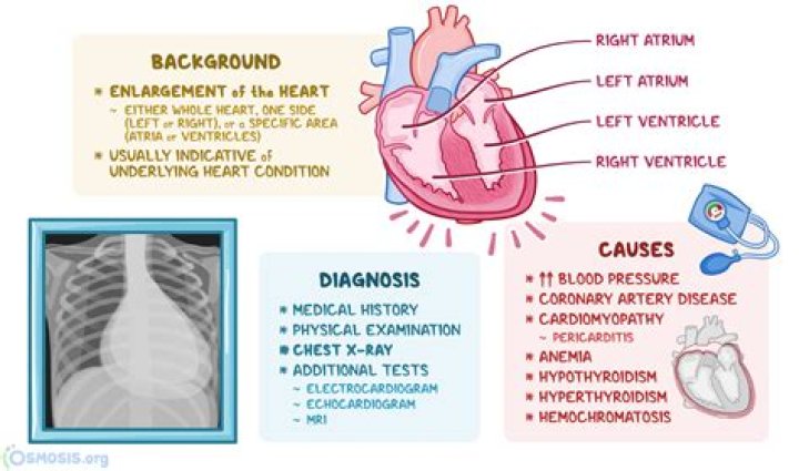 Who is at risk for cardiomegaly?