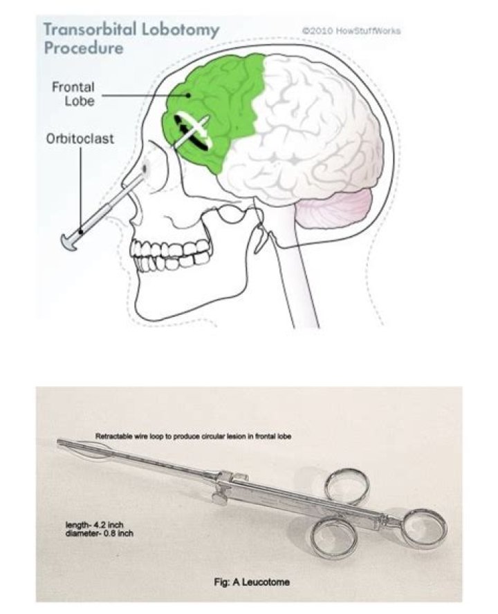 Who made frontal lobotomy?