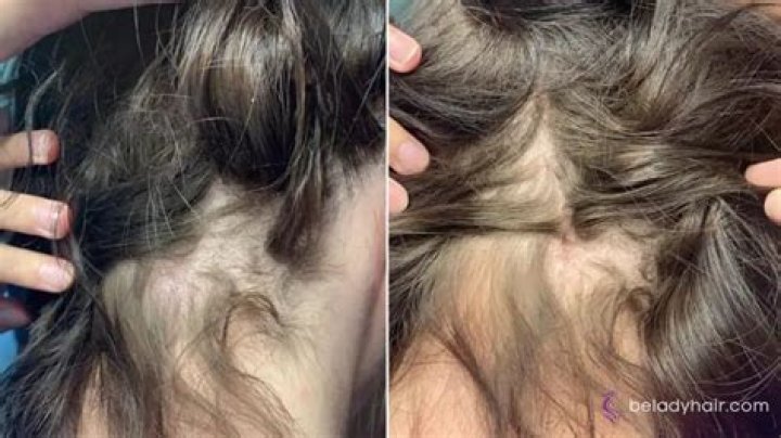 Why are clumps of hair falling out?