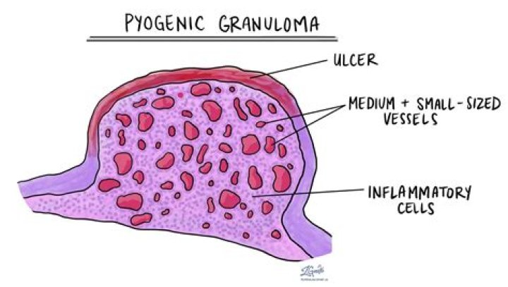 Why do hemangiomas bleed?
