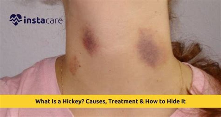 Why hickeys are dangerous?