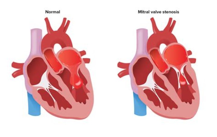 Why is mitral stenosis a diastolic murmur?