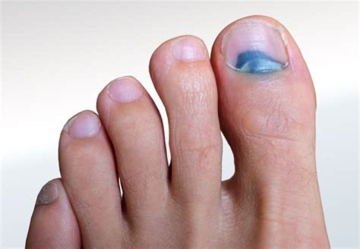 Will a black and blue toenail fall off?