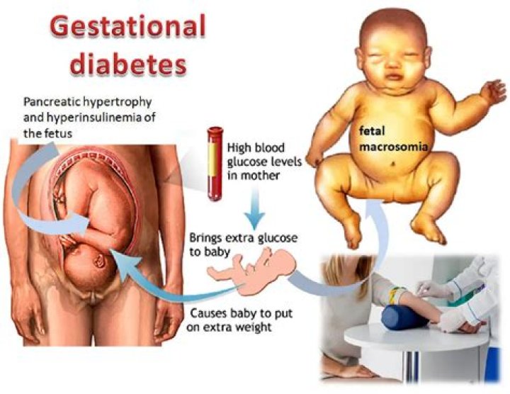 Will gestational diabetes lead to diabetes?
