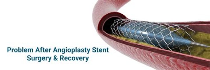 Will i feel better after angioplasty?