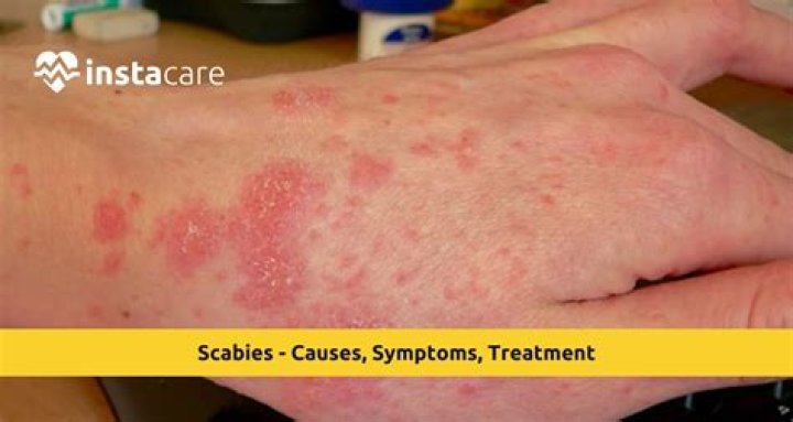 Will scabies stay in one spot?