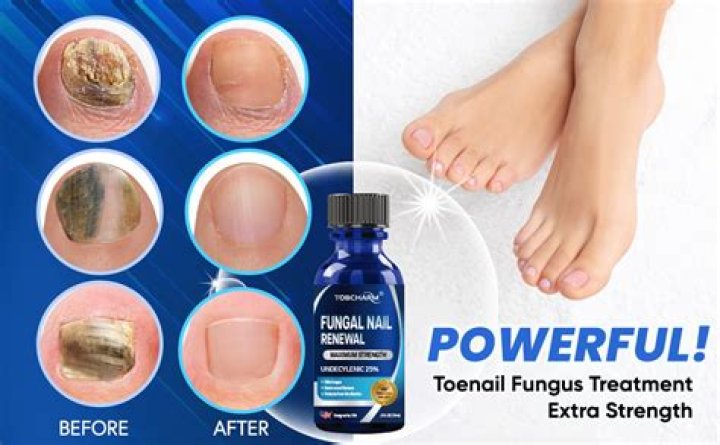 Will vaporub cure toenail fungus?